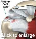 rotator cuff tear